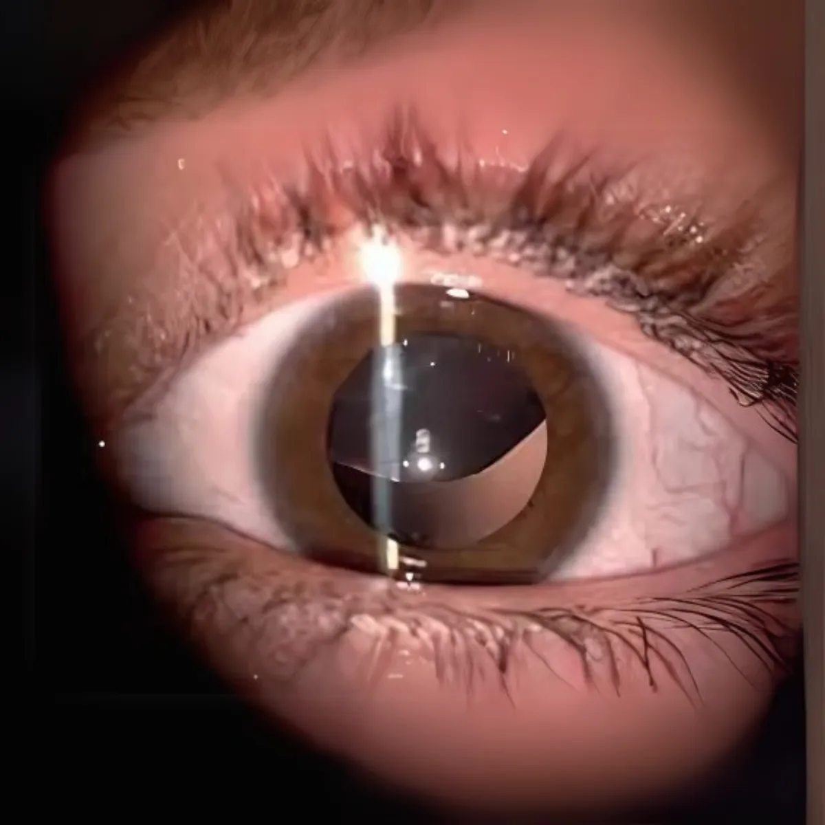 Imagem animada de cristalino subluxado oscilando com os movimentos oculares