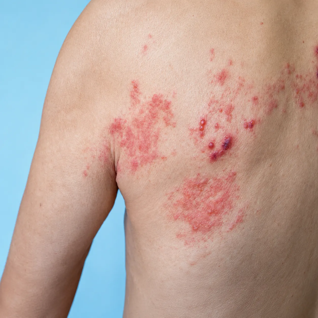 Herpes Zoster - Foto 3
