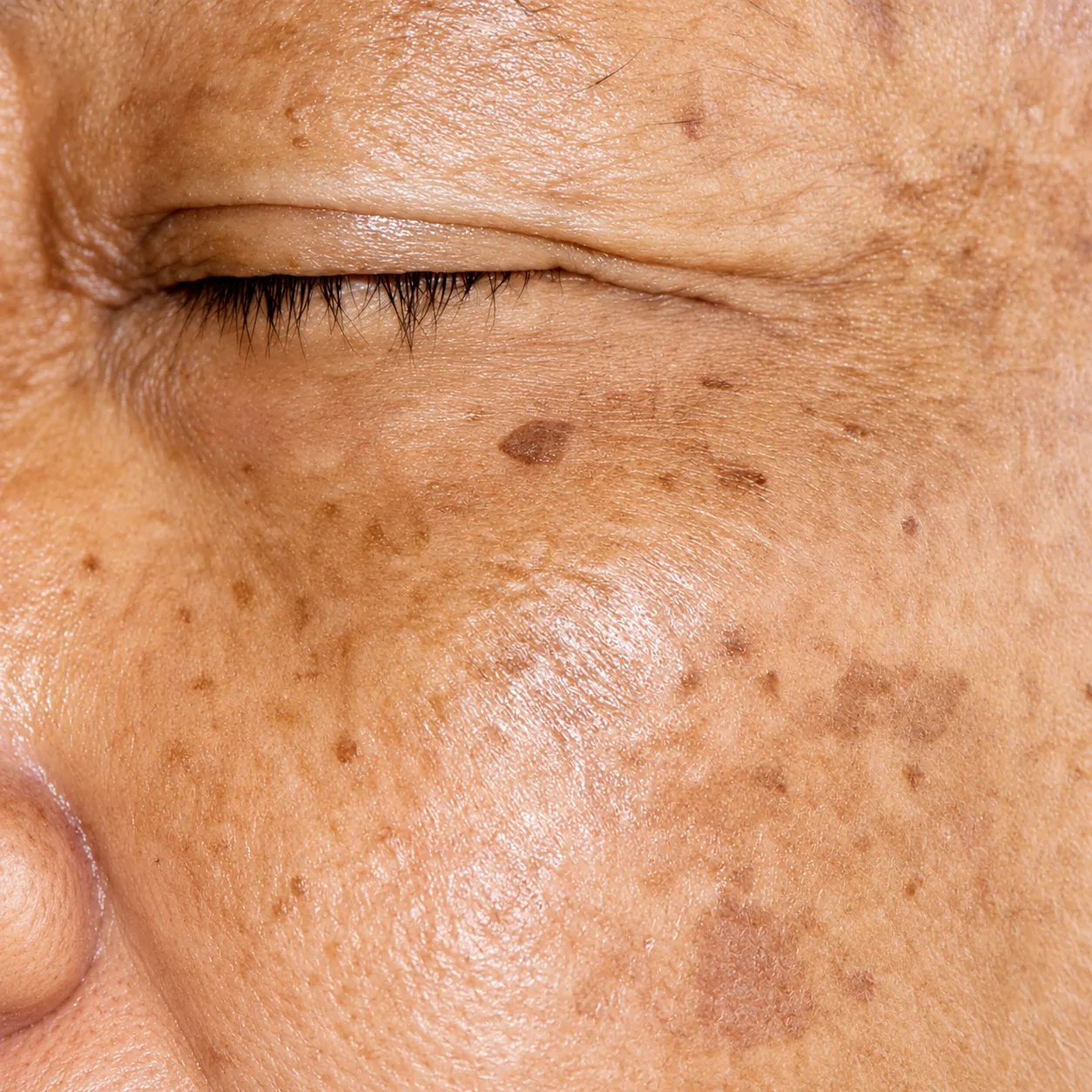 Melasma facial