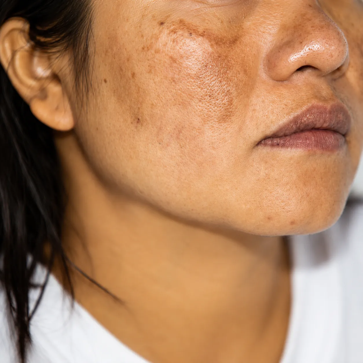 Melasma em face