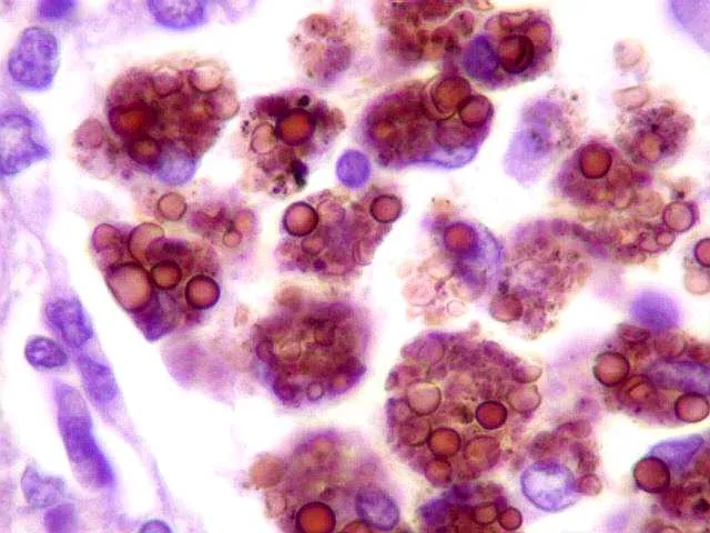 Histoplasma capsulatum