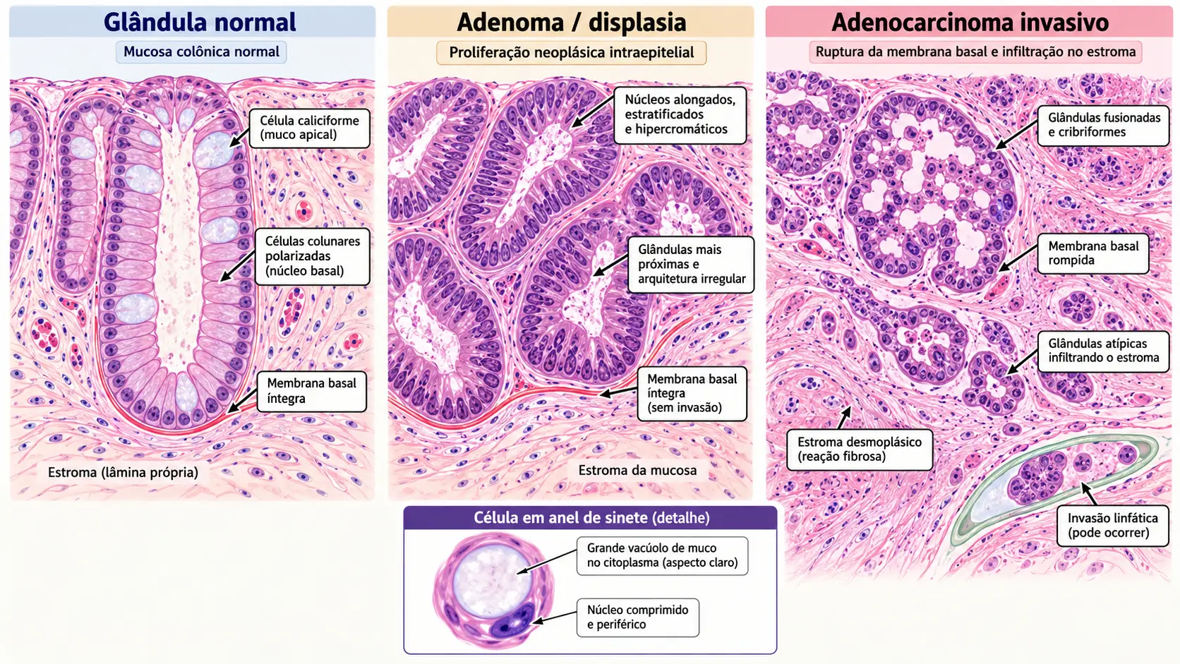 Esquema da glândula normal ao adenocarcinoma invasivo
