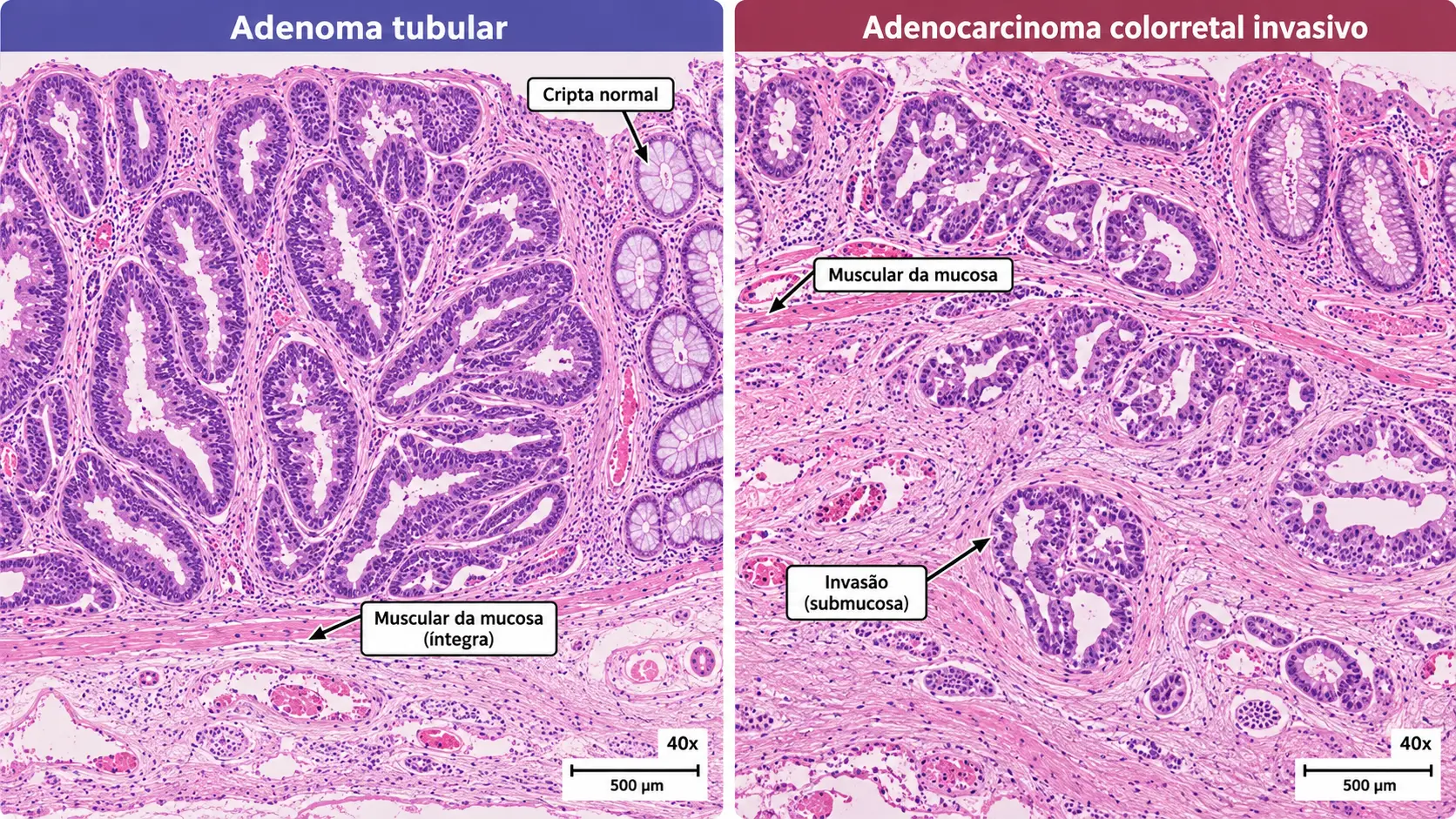 Adenoma tubular e adenocarcinoma invasivo de cólon lado a lado, HE