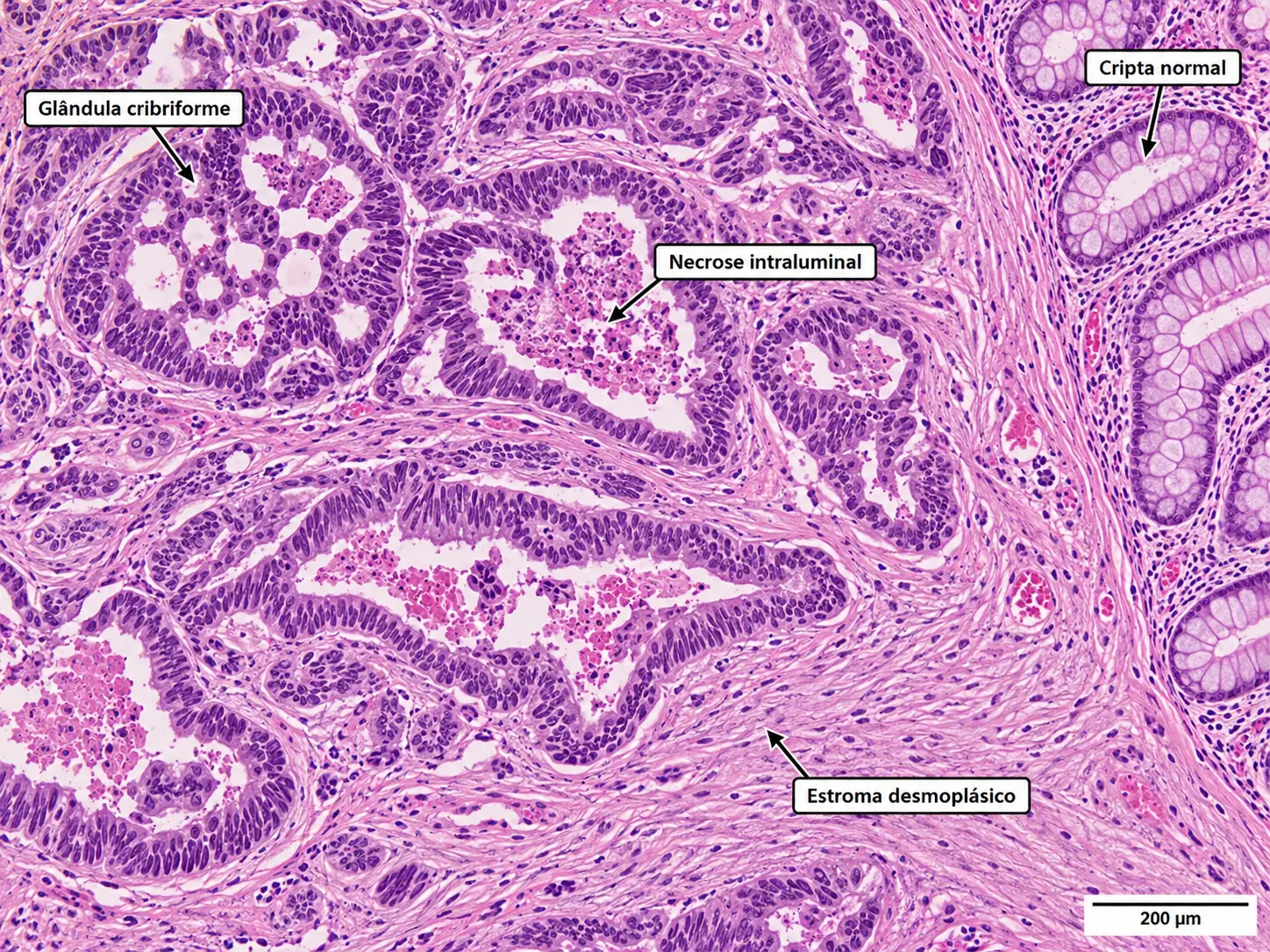 Adenocarcinoma colorretal moderadamente diferenciado, HE